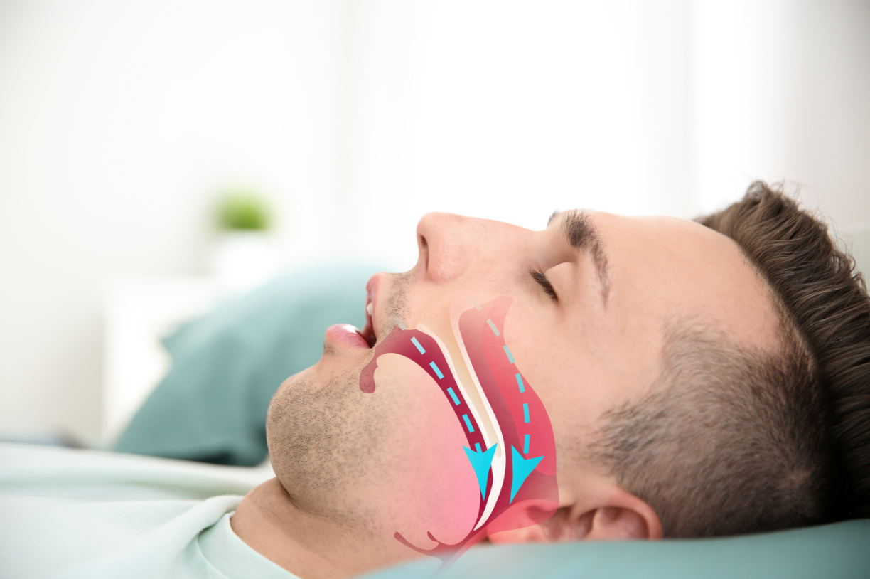 Hội chứng ngưng thở khi ngủ khiến bệnh nhân mơ thấy mình bị nghẹt thở.